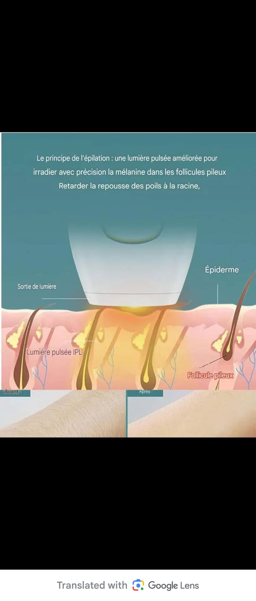 Épilateur laser